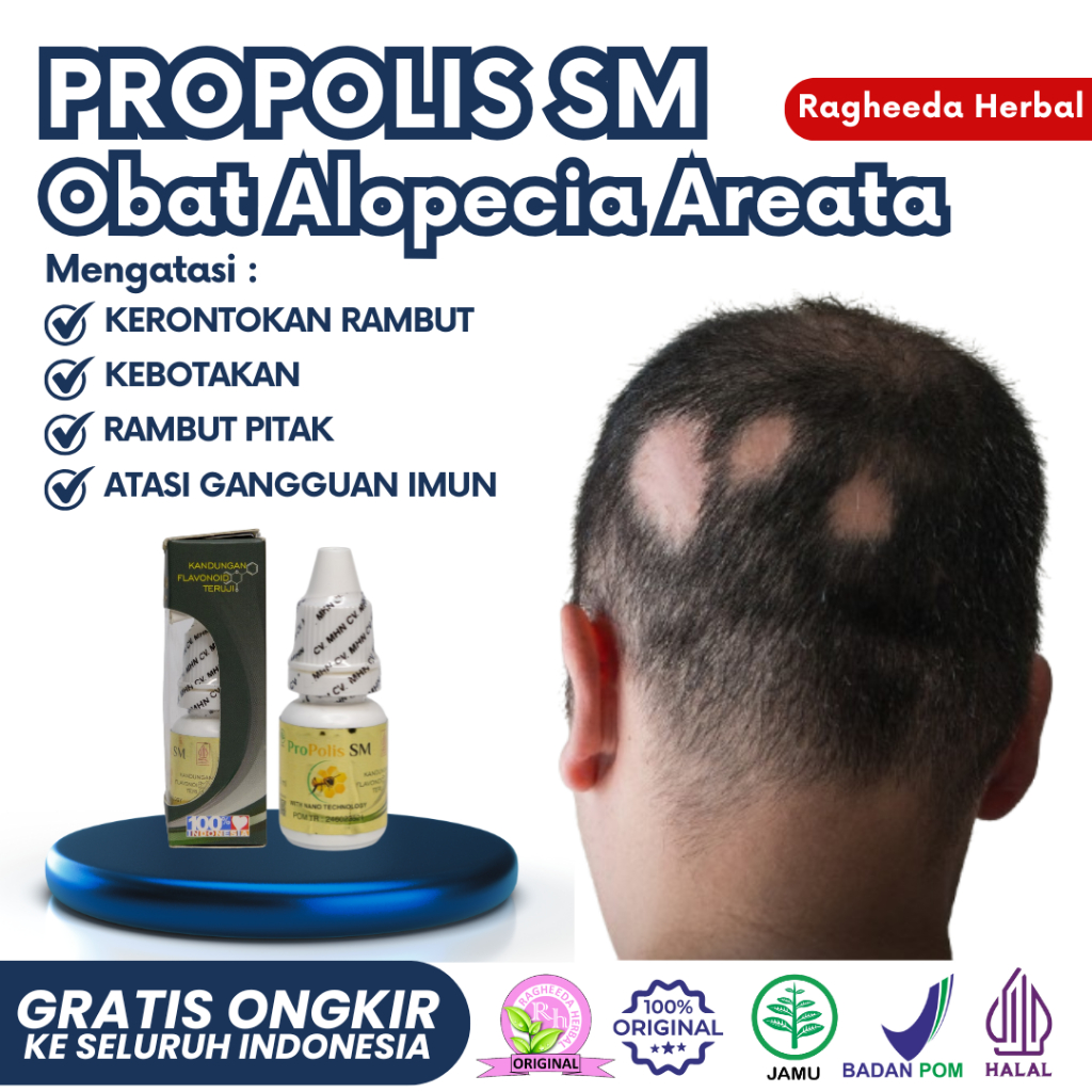 Obat Alopecia Areata, Serum Penumbuh Rambut untuk Rambut Rontok, Pitak, dan Botak