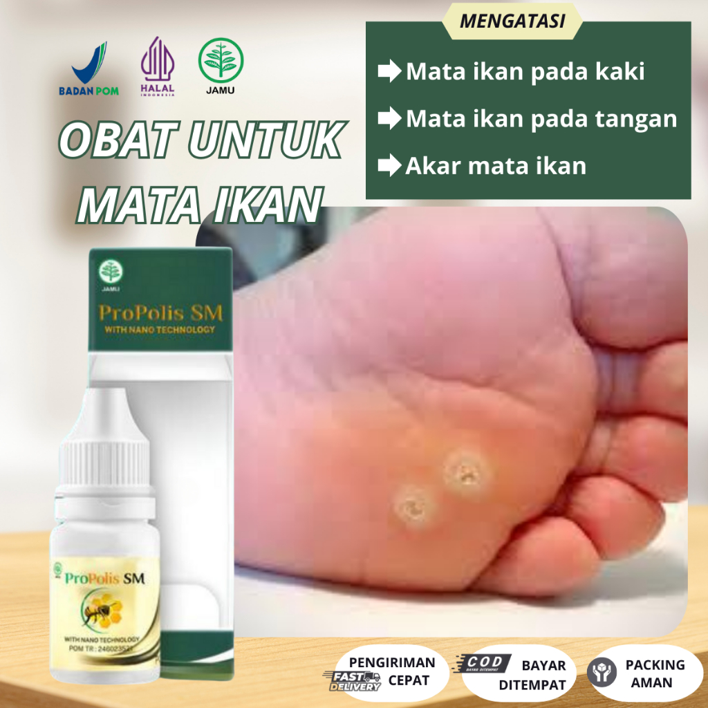 Obat Mata Ikan Pada Telapak Kaki, Kapalan di Kaki / Tangan- penghilang Mata ikan di kaki, Pembersih 