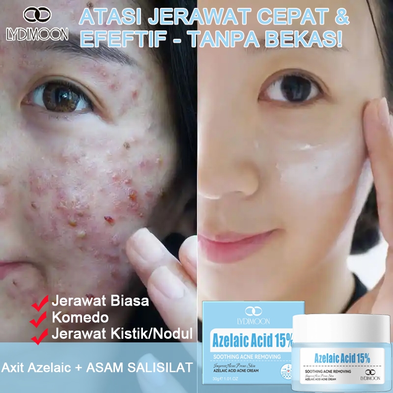 cream jerawat dan bekas jerawat cream acne penghilang bekas jerawat 30g menghilangkan bekas jerawat 