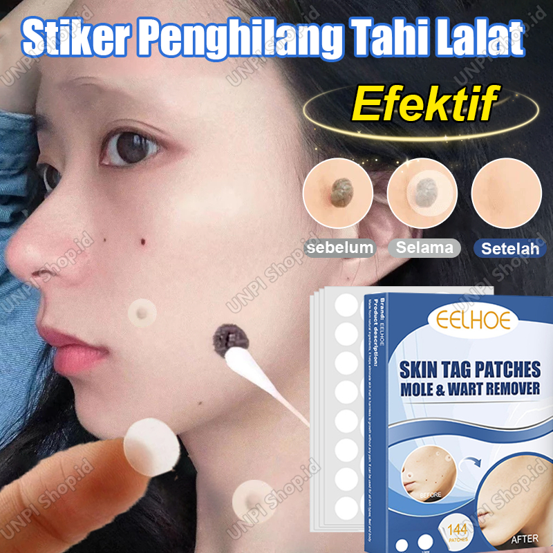 Stiker Penghilang Tahi Lalat Di Wajah Penghilang Kutil Dan Tahi Lalat Obat Kutil Di Leher Plester Ma