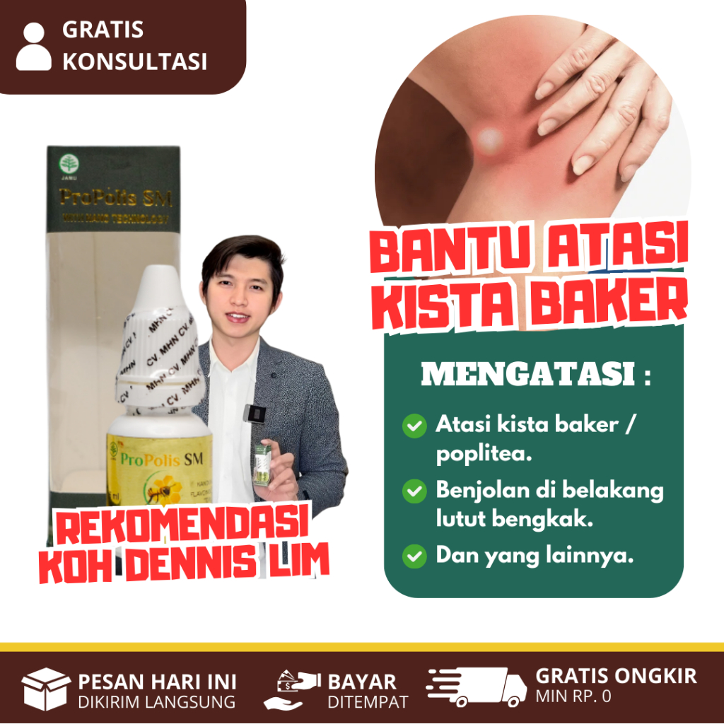 PROPOLIS SM Obat Kista Baker / Kista Poplitea Benjolan Di Belakang Lutut Bengkak dan Sakit
