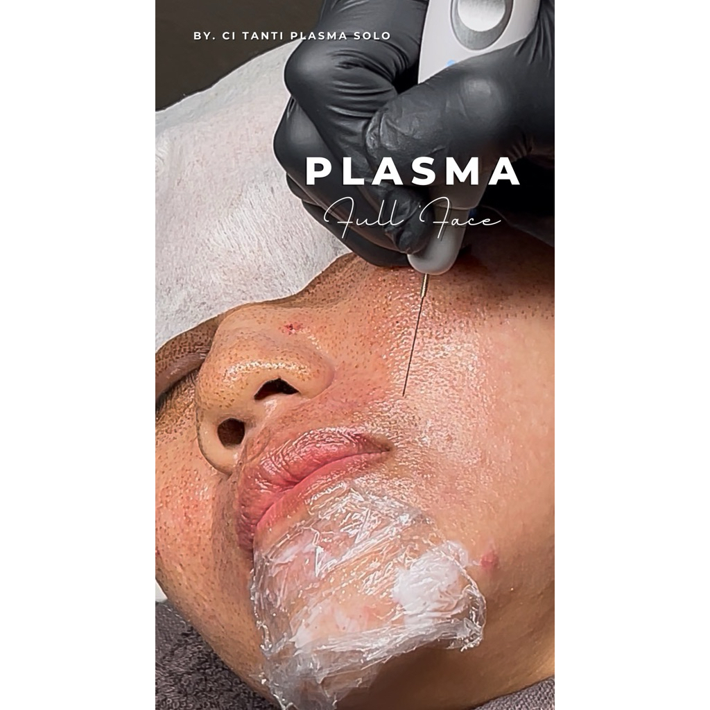 Plasma Fibroblast Full Face