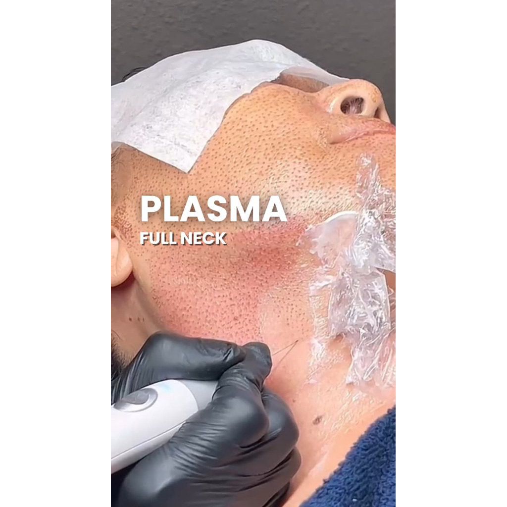 Plasma Fibroblast Full Neck