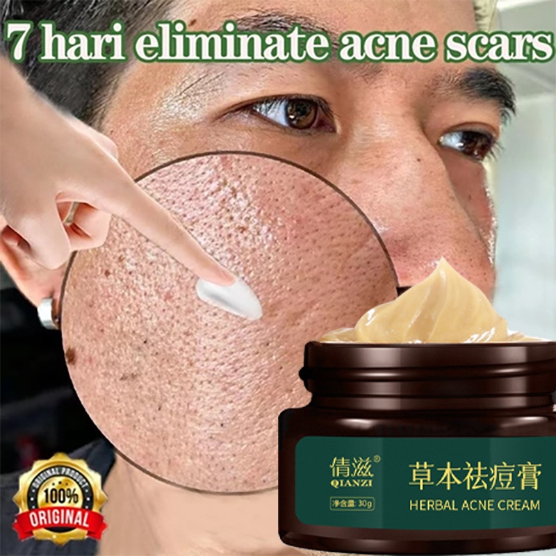 30g Ampuh Cream Penghilang Jerawat permanen bpom penghilang bekas jerawat bopeng bekas jerawat pria 