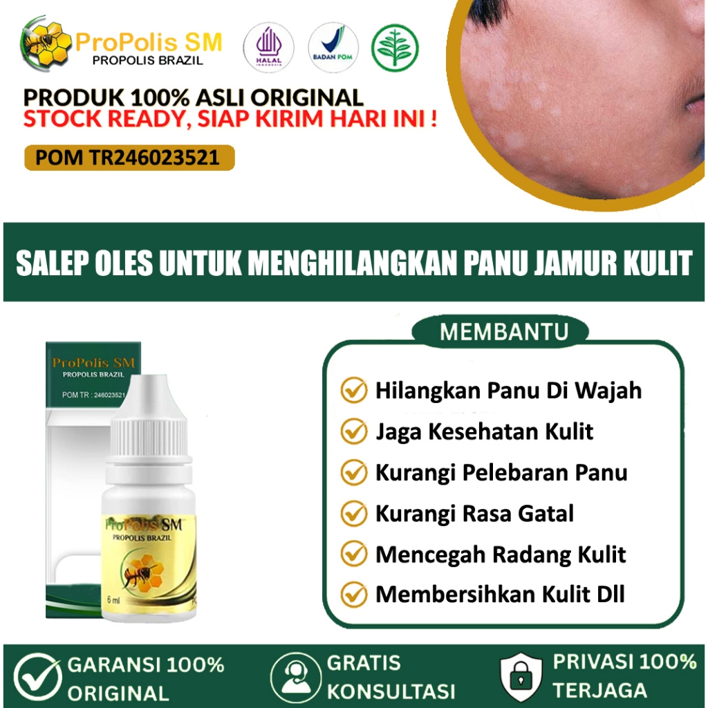 Obat Hapur Kulit, Bercak Putih Di Wajah, Penghilang Panu Di Wajah, Obat Oles  Penghilang Balas Bogo 