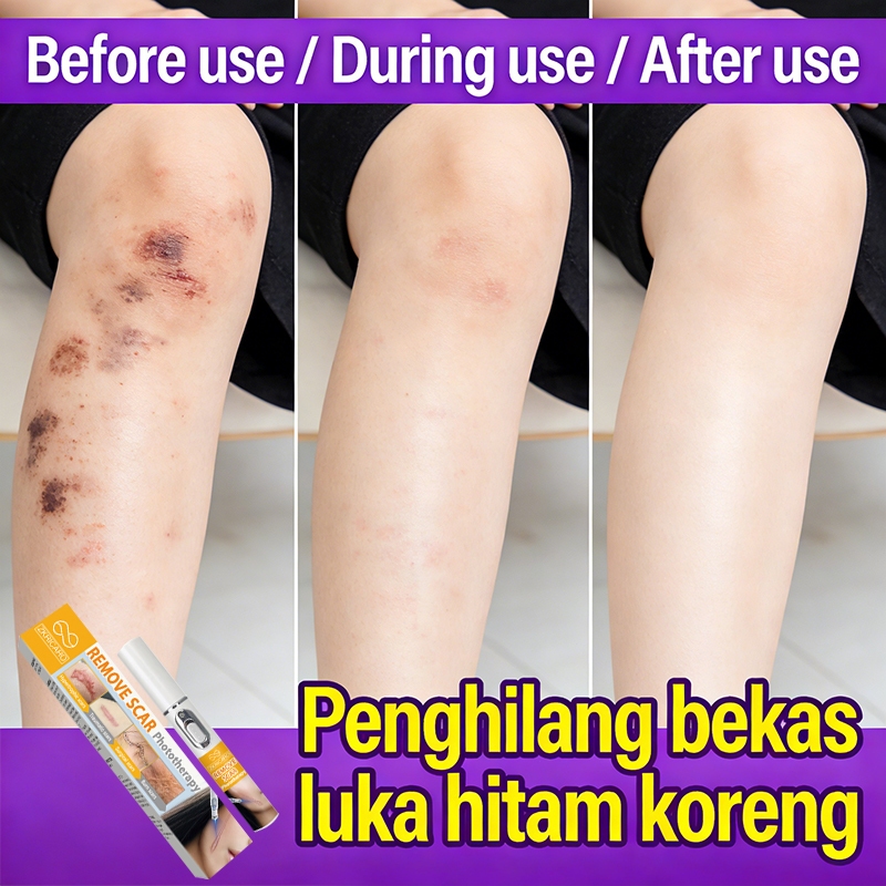 Penghilangan bekas luka dengan laser – untuk peremajaan kulit, bekas luka baru, bekas luka bakar, be