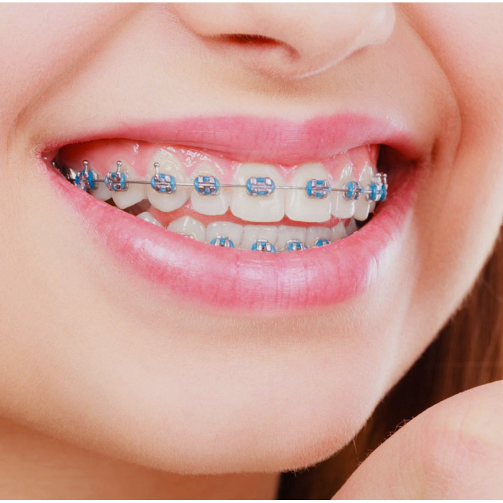 behel/kawat gigi metal