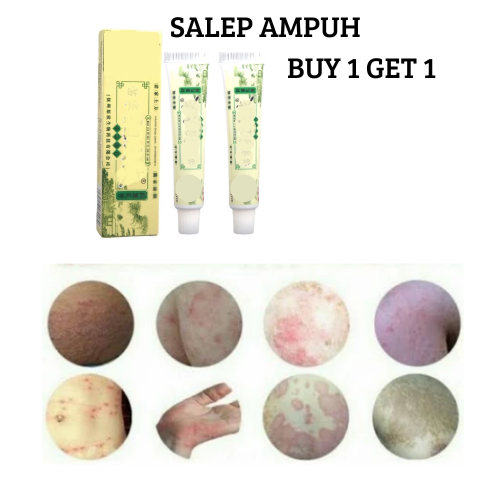 BUY 1 GET 1 Salep Ampuh Meredakan Gatal-Gatal Pada Tangan Kaki