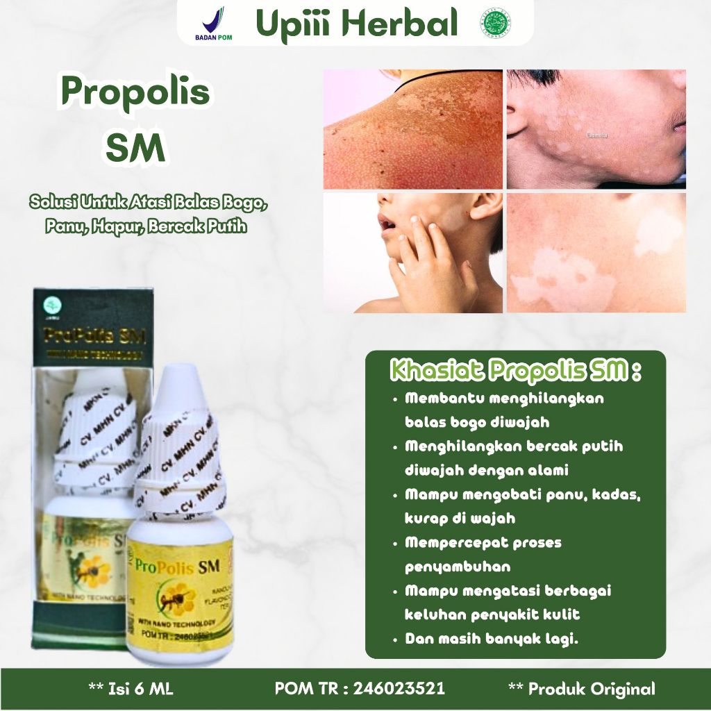 Obat Balas Bogo, Obat Untuk Penghilang Balas Bogo, Obat Penghilang Bercak Putih Di Wajah, Obat Panu,