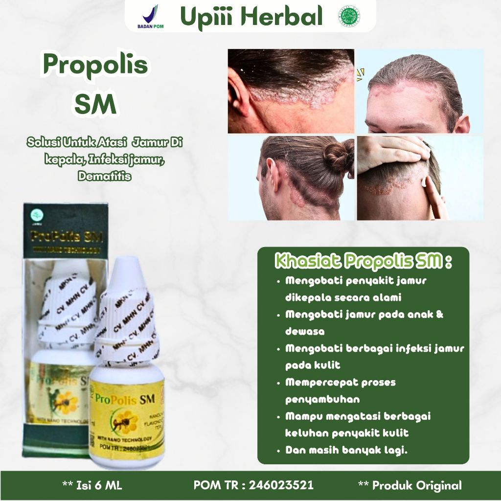 Obat Jamur Di Kepala Anak, Obat Jamur Kepala Tinea Kapititis, Obat Infeksi Jamur, Obat Penghilang Ku