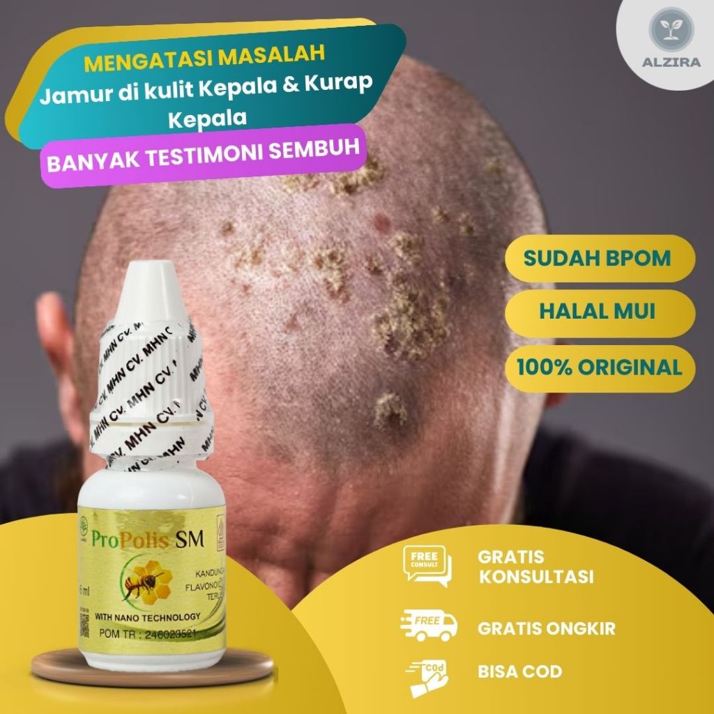 Alzira Herbal - Obat Jamur di kulit Kepala, Obat Kurap Kepala, Obat Psoriasis Kulit Kepala, Obat Kul