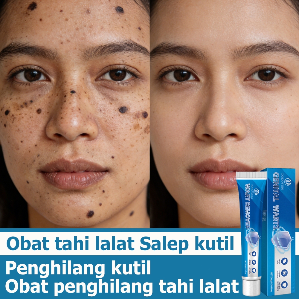 Obat penghilang tahi lalat Penghilang kutil dan tahi lalat Penghilang kutil Penghilang tahi lalat 1 