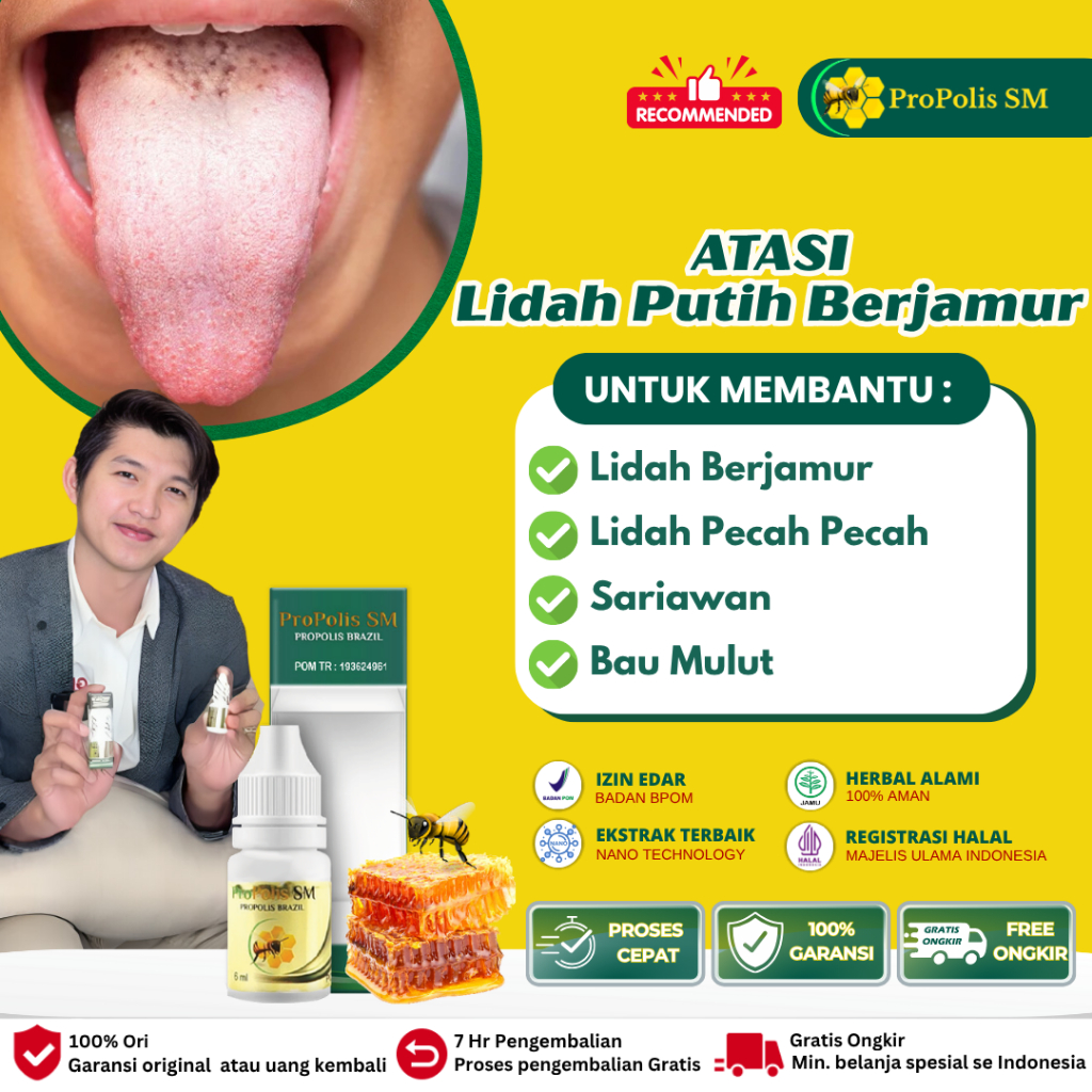 Propolis Sm Original Obat Lidah Berjamur, Obat Pembersih Lidah Putih Putih, Lidah Putih Terasa Pahit