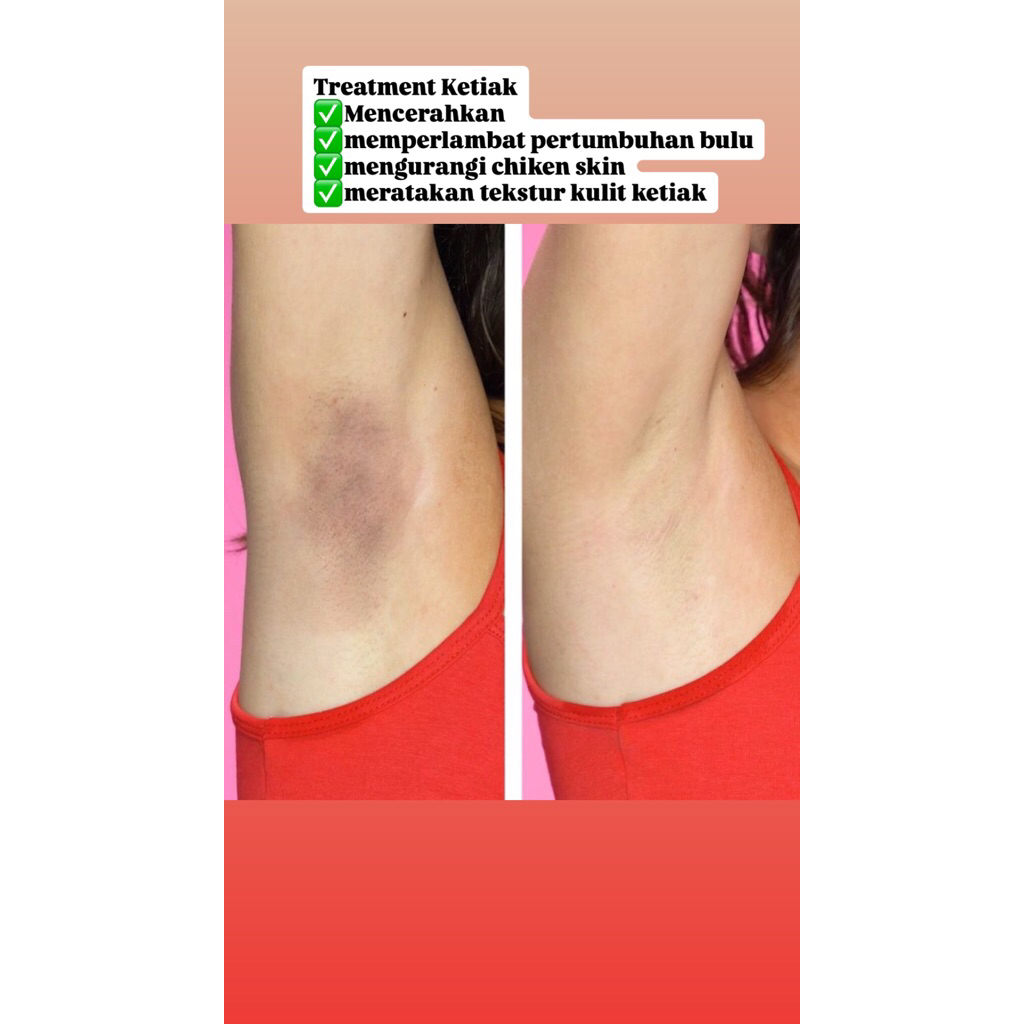 [Treatment Underarm] IPL + LASER + PELING KETIAK