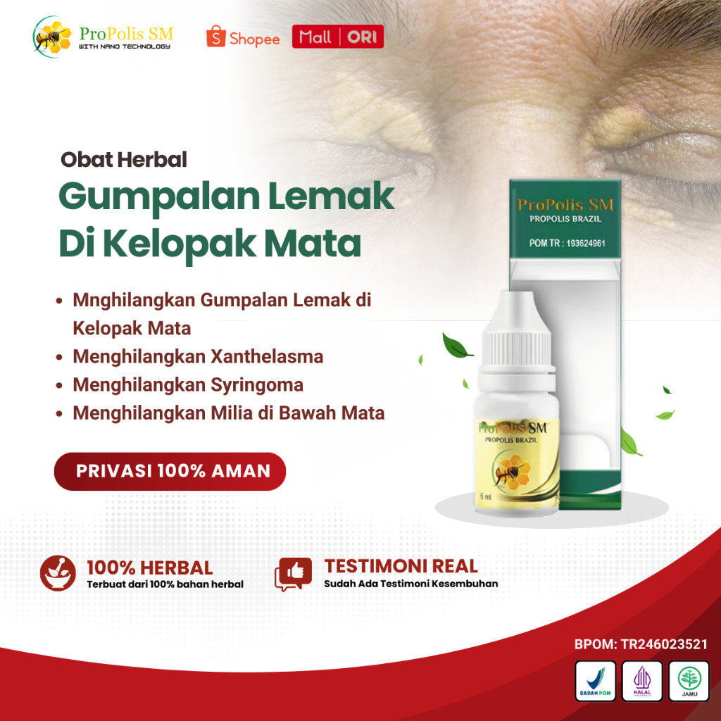 Obat Gumpalan Lemak di Kelopak Mata Penghilang Xanthelasma Syringoma Milia dengan Propolis SM