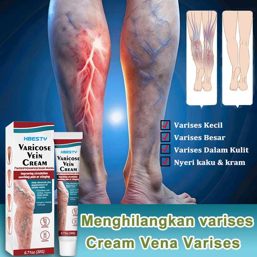Obat Varises Varicose Veins Cream Obat Varises Salep Penghilang Varises Vaskulitis /Ampuh Tanpa Oper