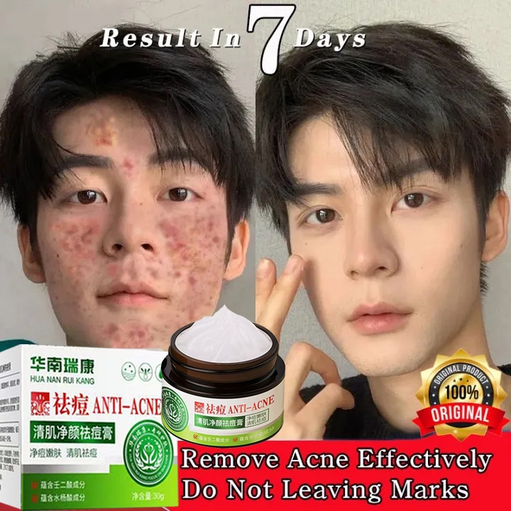 Penghilang Bekas Jerawat Krim jerawat Penghilang Bopeng Krim  mengecilkan pori pori wajah Obat jeraw