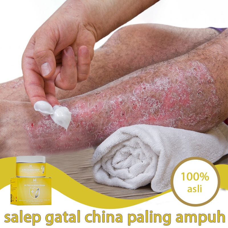 Obat gatal selangkangan dan hitam salap gatal china salep kulit salep eksim kering dan gatal 20g sal