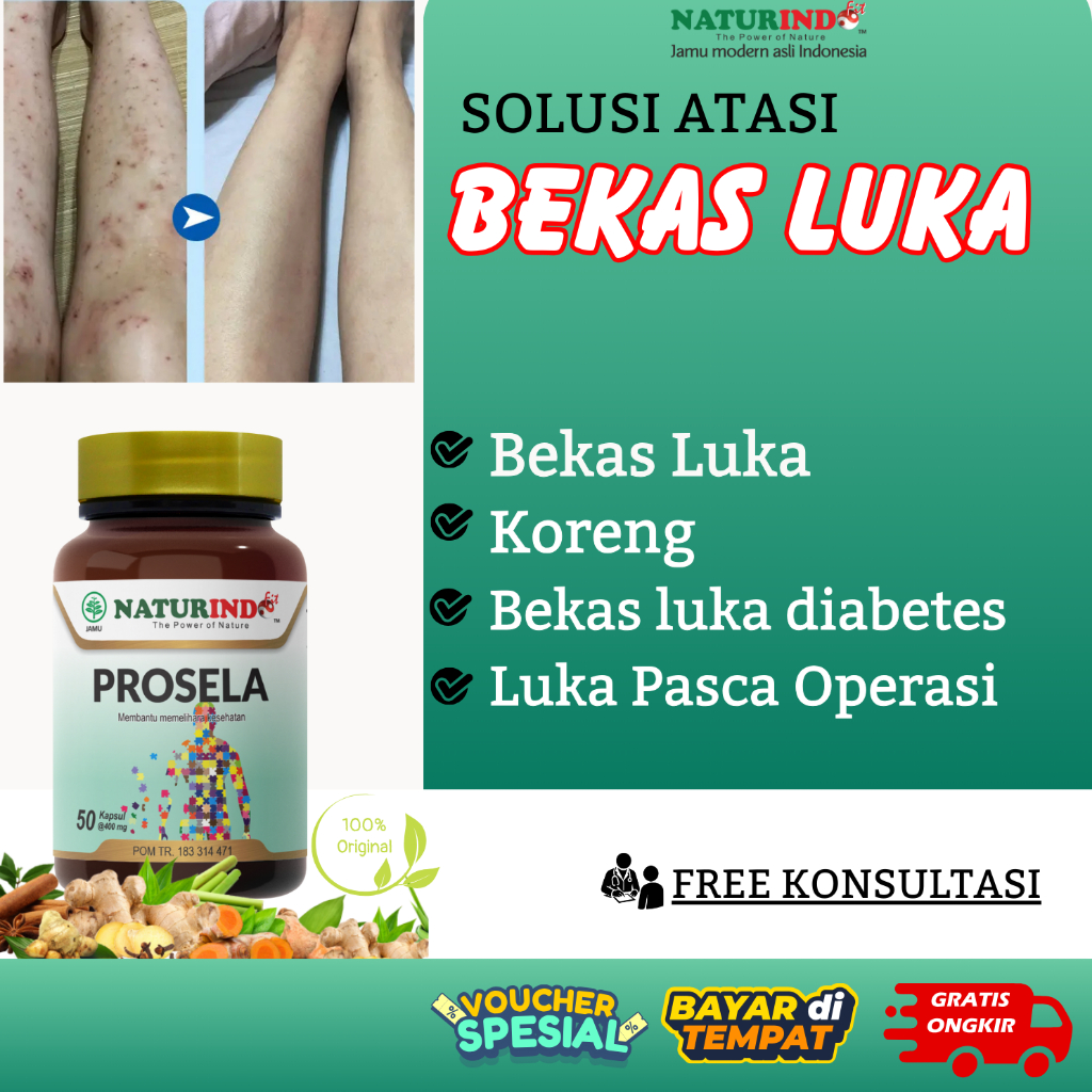 PROSELA - NATURINDO Obat Menghilangkan Bekas Luka Jerawat Koreng Borok Menghitam Paling Ampuh