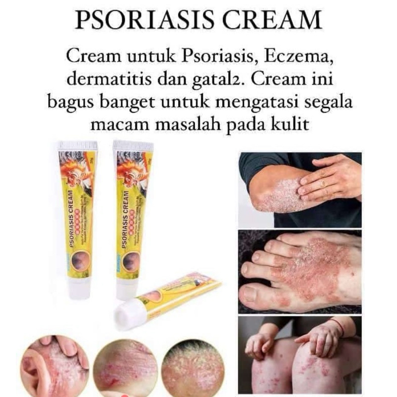 Psoriasis Cream