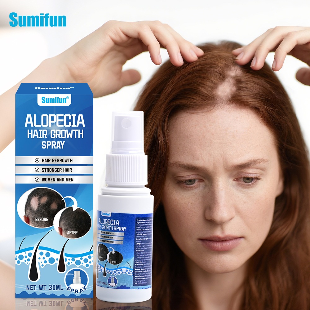 30G Obat Pitak, Krim Penumbuh Rambut 30g untuk Alopecia Areata dan Rambut Rontok Obat Botak Koin, Ob