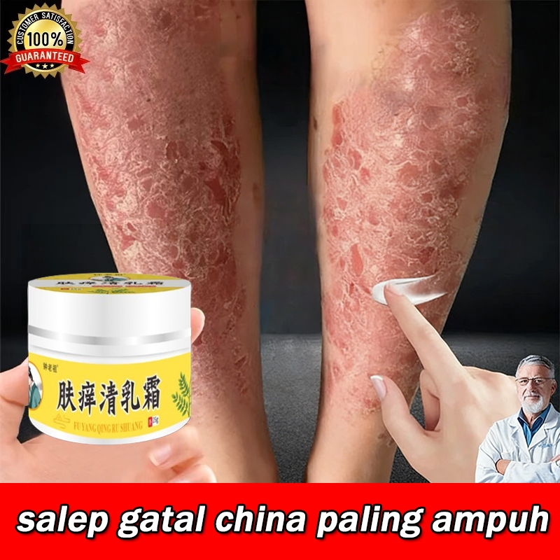 salep eksim kering dan gatal salep gatal china paling ampuh original 100% asli obat gatal selangkang
