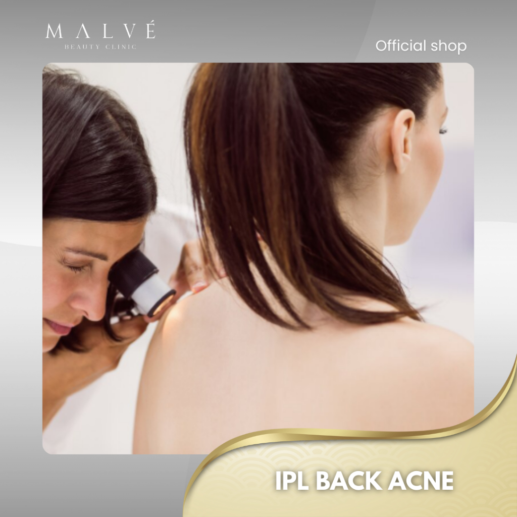 MALVE IPL Back Acne Treatment
