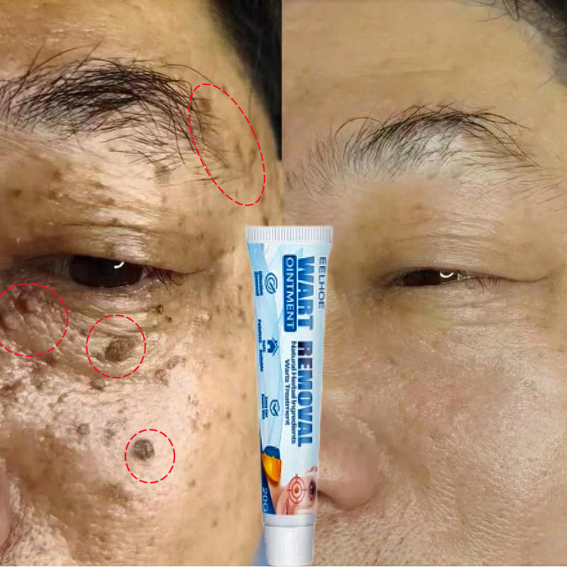 Obat kutil Salep kutil paling ampuh Penghilang kutil Wart removal Ointment Menghilangkan Kutil Wajah