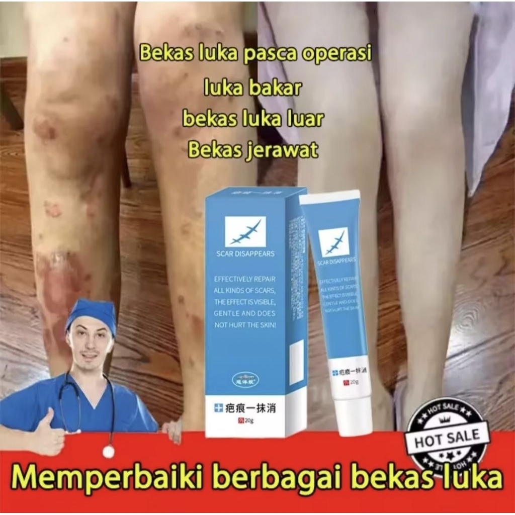 Scar removing cream Scar constitutionSalep Penghilang Bekas Luka PenghilangBekas Luka Bakar Strech m