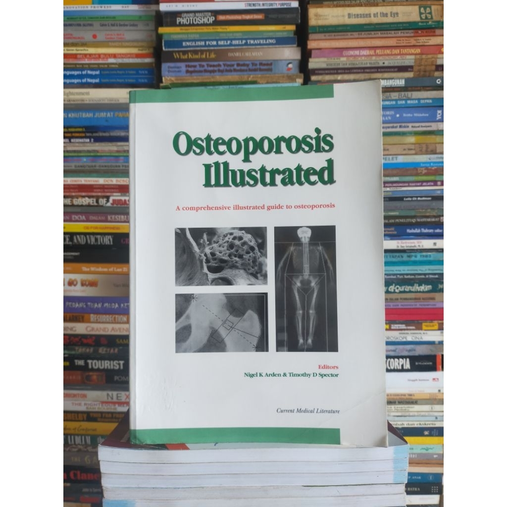 Buku Original (Import) : OSTEOPOROSIS ILLUSTRATED A Comprehensive Illustrated guide to Osteoporosis