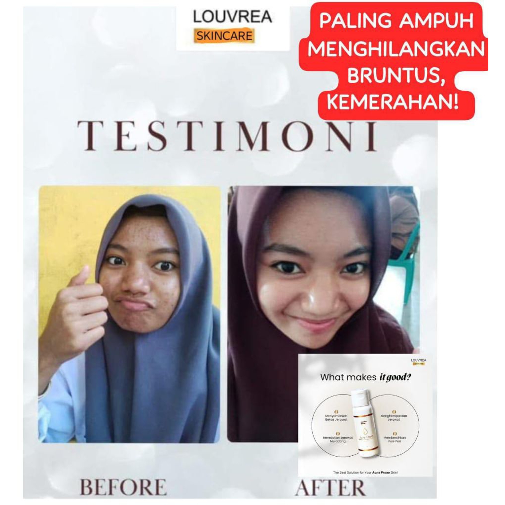 [Terlaris] Acne drop Louvrea skincare cepat keringkan jerawat, bruntus, kemerahan.
