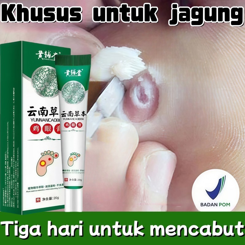 Obat Mata Ikan Pada Telapak Kaki, Perontok Mata Ikan di Telapak Kaki & Tangan / Benjolan Keras di Te