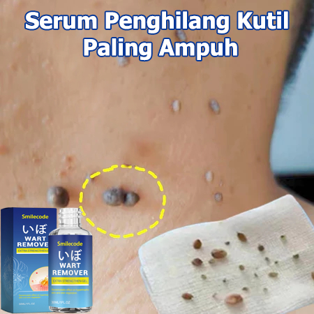 Penghilang tahi lalat Obat penghilang tahi lalat Obat tahi lalat Penghilang tahi lalat di wajah Peng