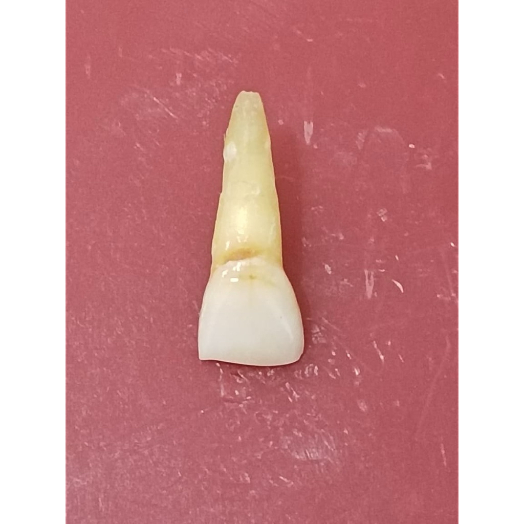 gigi insisivus rahang atas (gigi 21)