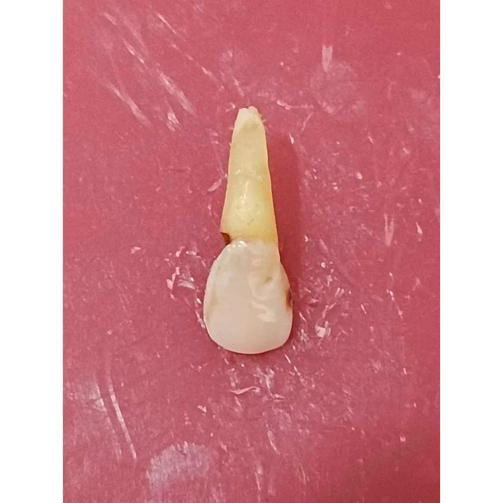 Gigi insisivus rahang atas (gigi 12)