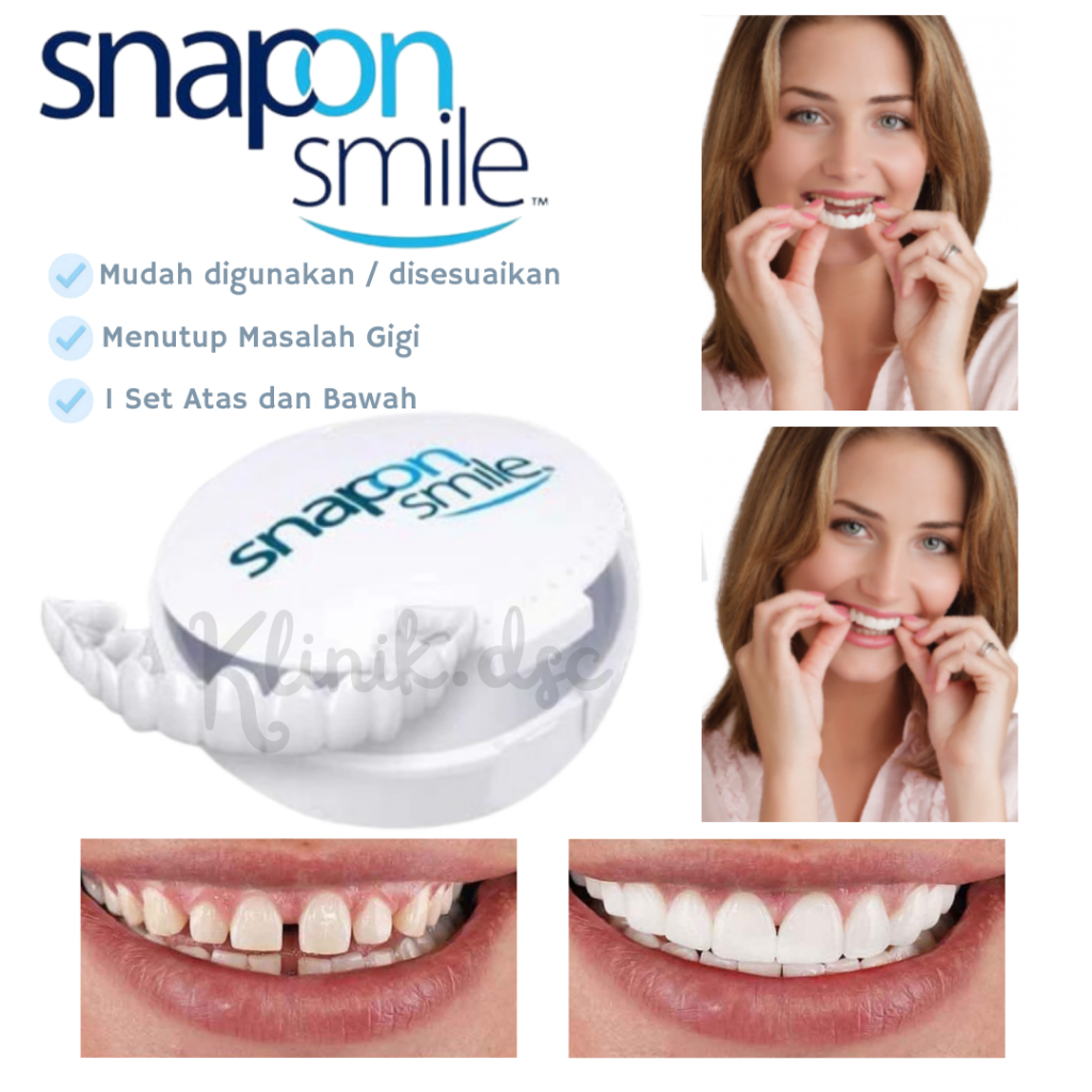 Veneer Gigi Palsu Sepasang - Lapisan Pemutih Gigi Sepasang
