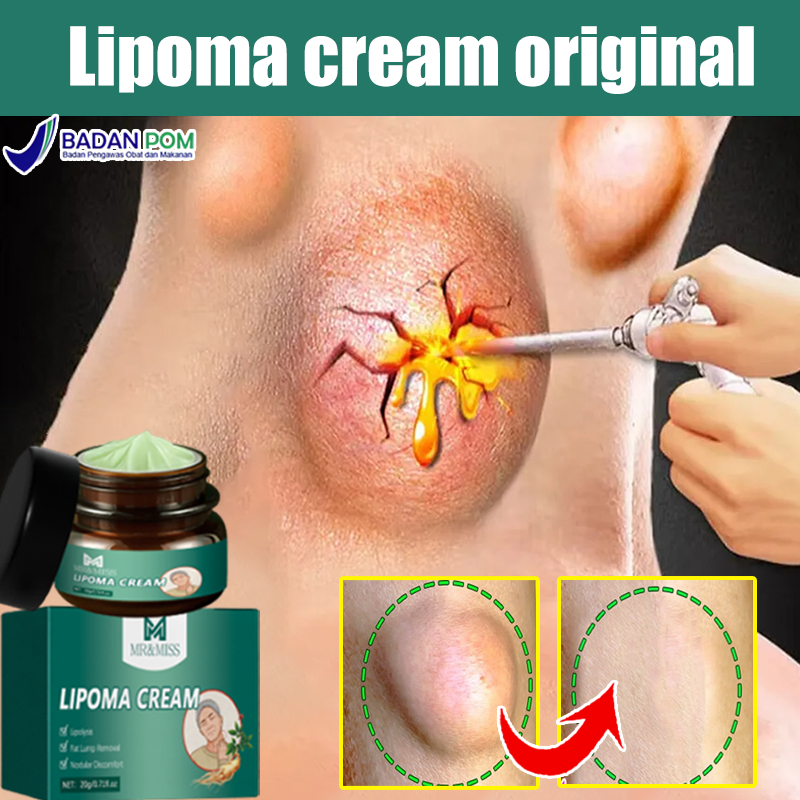 Lipoma krim untuk benjolan obat benjolan lipoma salep benjolan ampuh 30g lipoma removal cream origin
