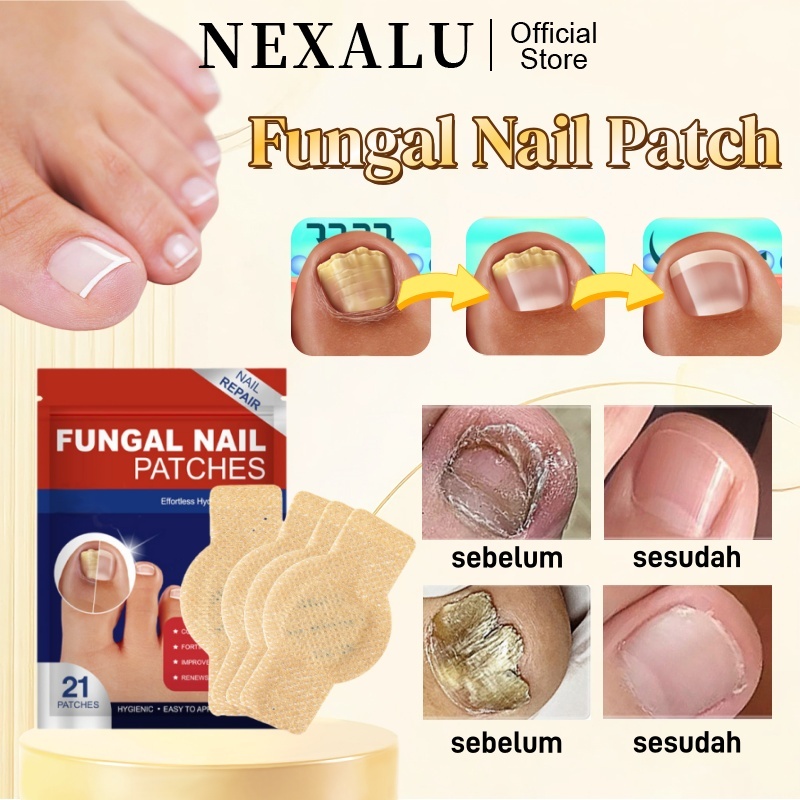 NEXALU Obat Jamur Kuku Kaki Dan Tangan Obat Cantengan Obat Kuku Rusak Fungal Nail Treatment Fungal N