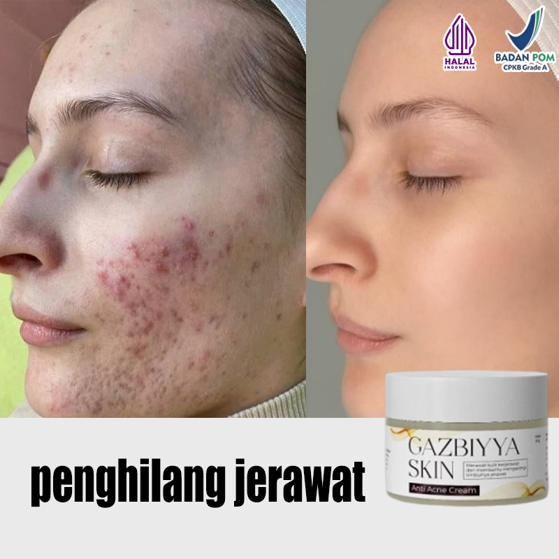 Totol jerawat dan bekas jerawat Jerawat dan bekas jerawat ampuh Menghilangkan bekas jerawat Penghila