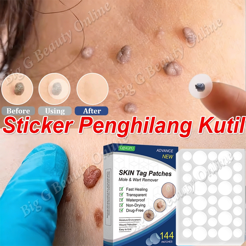 Sticker Penghilang Kutil Dan Tahi Lalat Obt Kutil Ampuh Penghilang Kutil Di Leher Wart Removal Patch