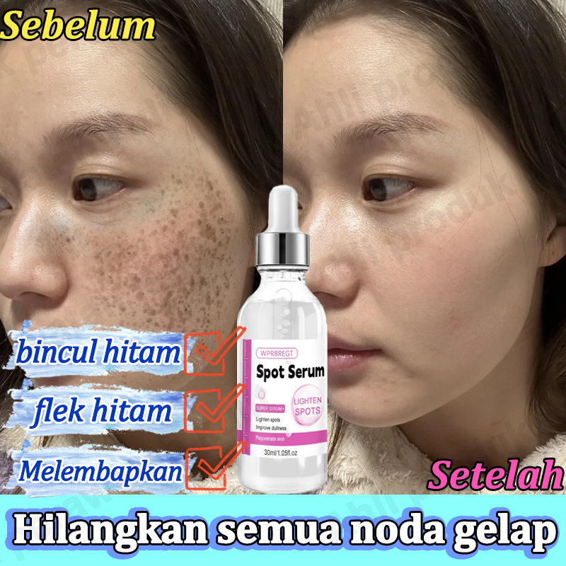 Serum penghilang bintik-bintik Menghilangkan kloasma dan bintik-bintik Menghilangkan bintik-bintik p