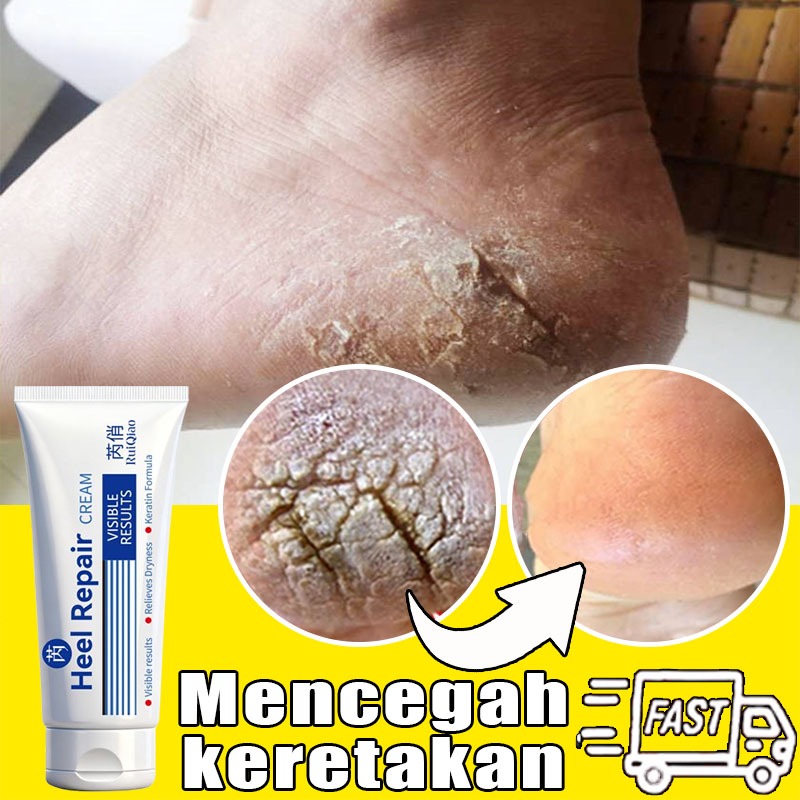 Cream Kaki Pecah Dan Kering Salep Kaki Pecah2 Paling Ampuh Obat Kaki Pecah Pecah Foot Cream krim kak