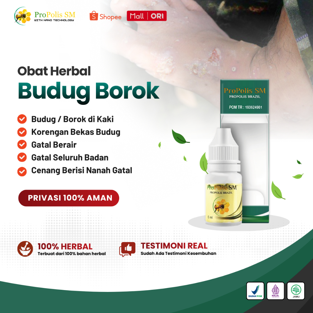 Obat Budug / Borok di Kaki, Obat Penghilang Bekas Budug Borok Bernanah Basah - Propolis SM