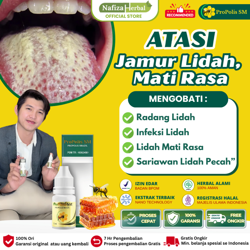 Propolis Sm Obat Kandidiasis Mukokutan Lidah Putih Putih Berjamur, Obat Pembersih Lidah Putih, Lidah