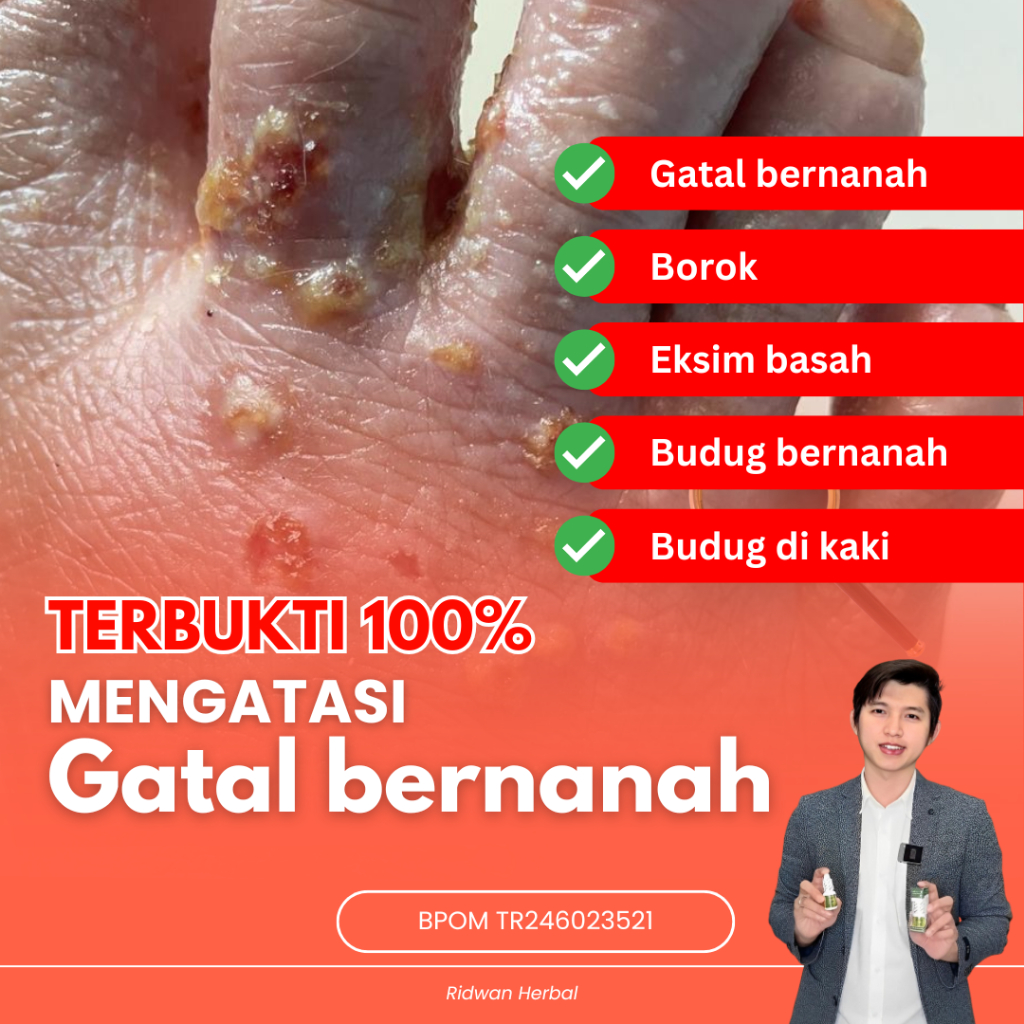 Obat Gatal bernanah, Obat budug dan gatal, Obat Budug, Obat Borok, Salep Scabies Manusia, Obat Budug