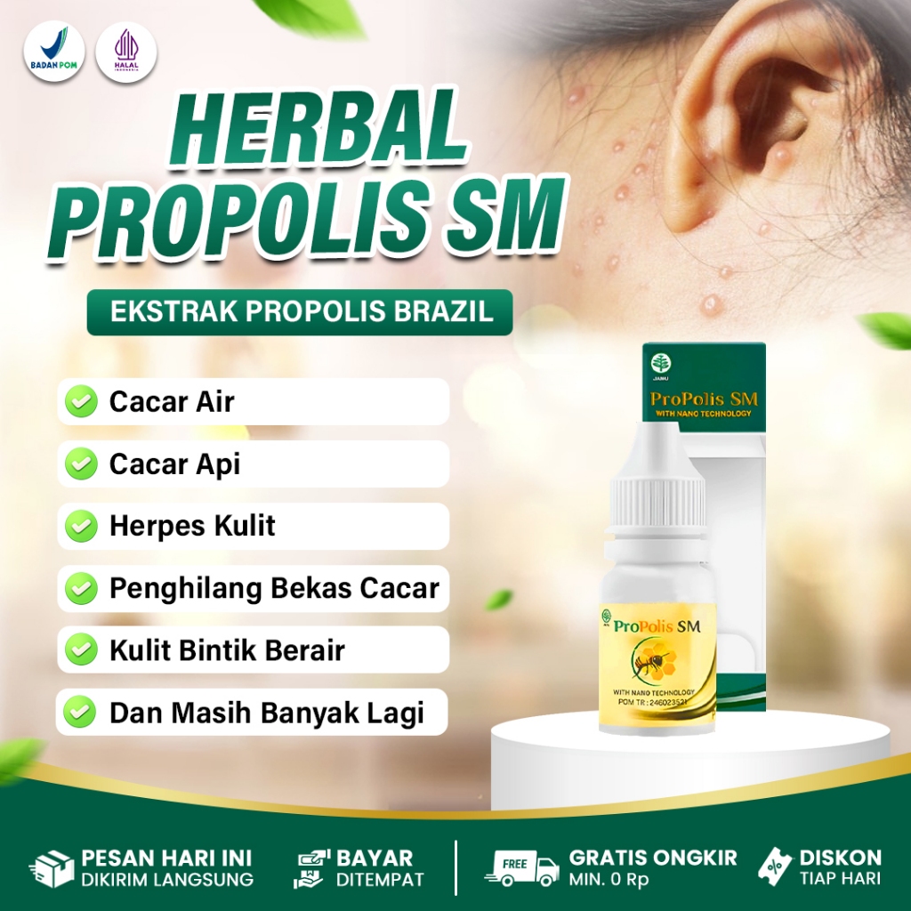 Obat Cacar Air, Cacar Api, Penghilang Bekas Cacar, Obat Luka Cacar Obat Herpes Kulit, Obat Cacar Mon