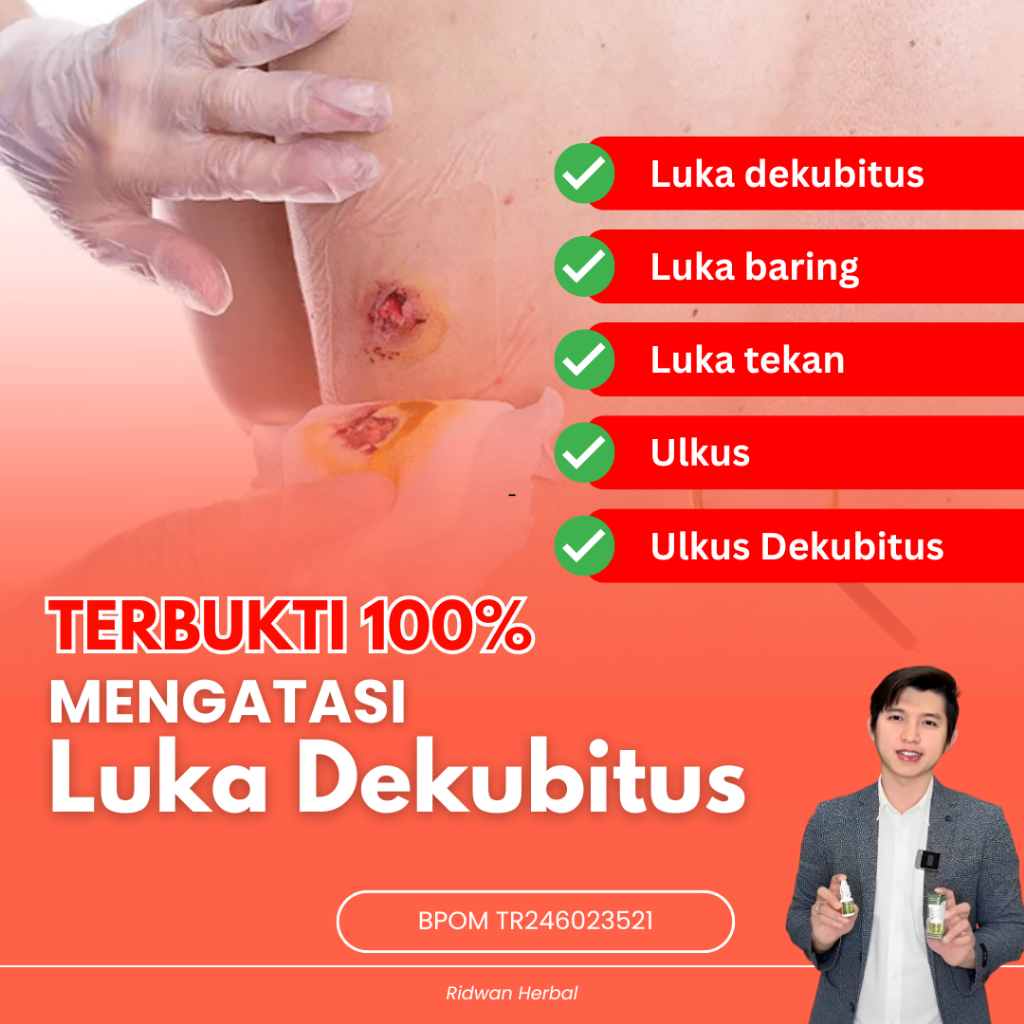 Obat luka dekubitus, Luka baring, luka tekan, Ulkus, Ulkus Dekubitus