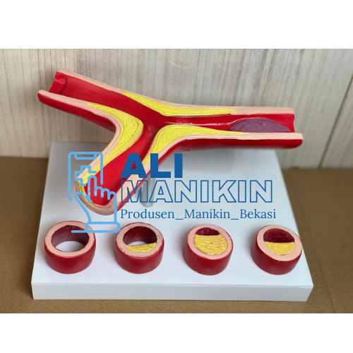 PROMO 50x Enlarged Atherosclerosis Vessel Model