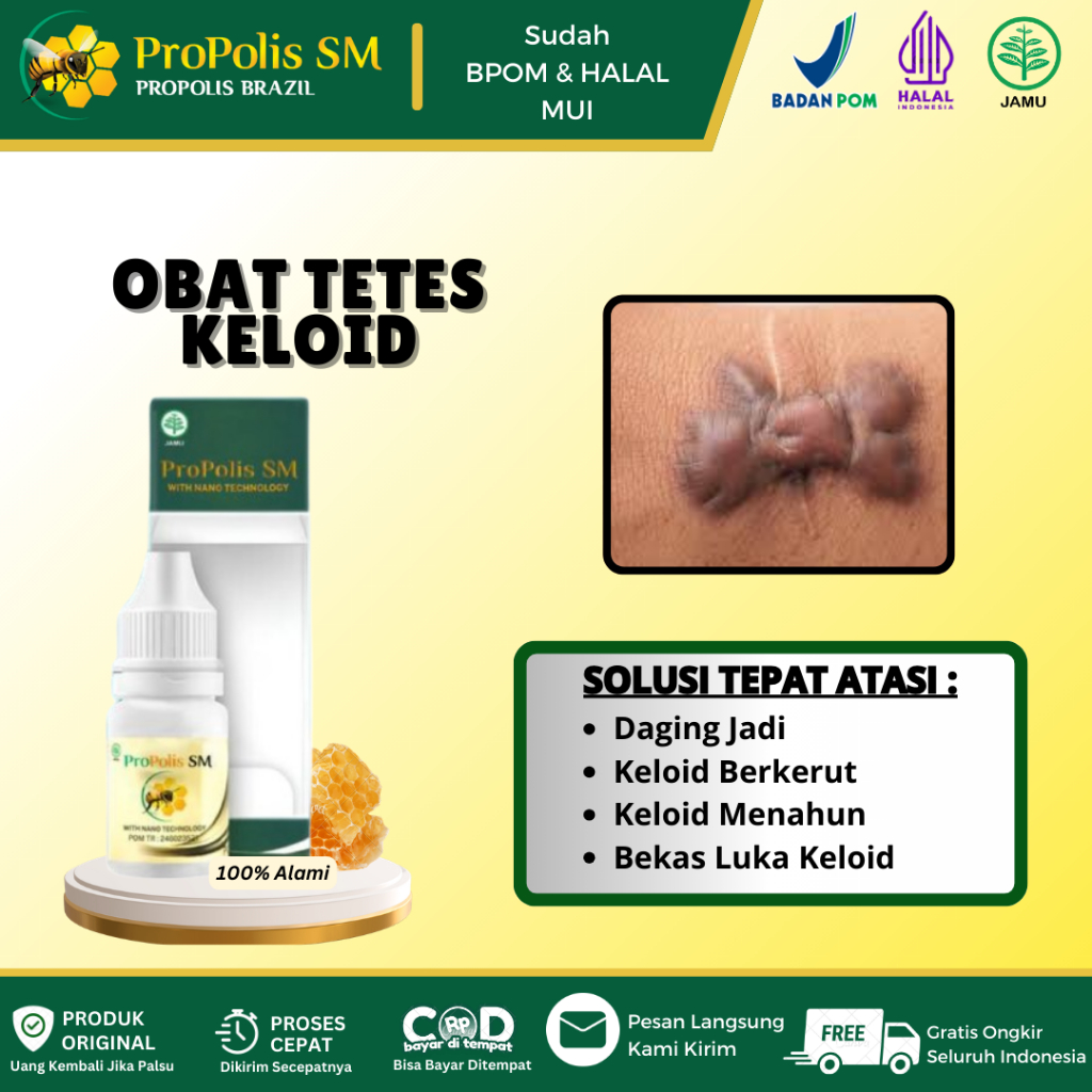 Propolis SM Obat Tetes Untuk Keloid, Daging Jadi, Keloid Berkerut, Penghilang Keloid Bekas Luka Deng