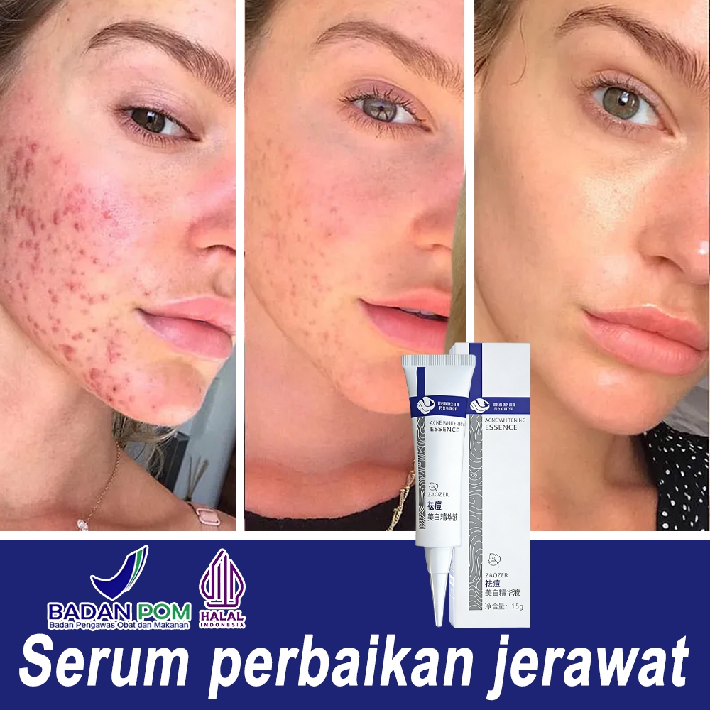 salep jerawat dan bekas jerawat menghilangkan bekas jerawat Bekas jerawat 20g menghilangkan jerawat 